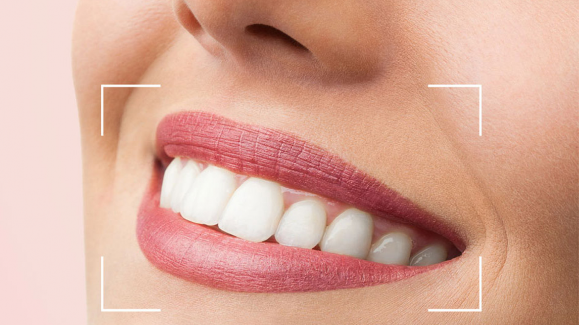 Was ist Smile-Design