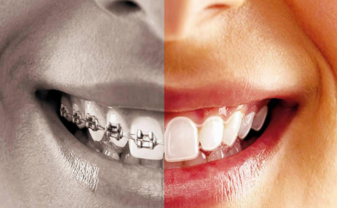 علاج تقويم الأسنان اللاسلكي