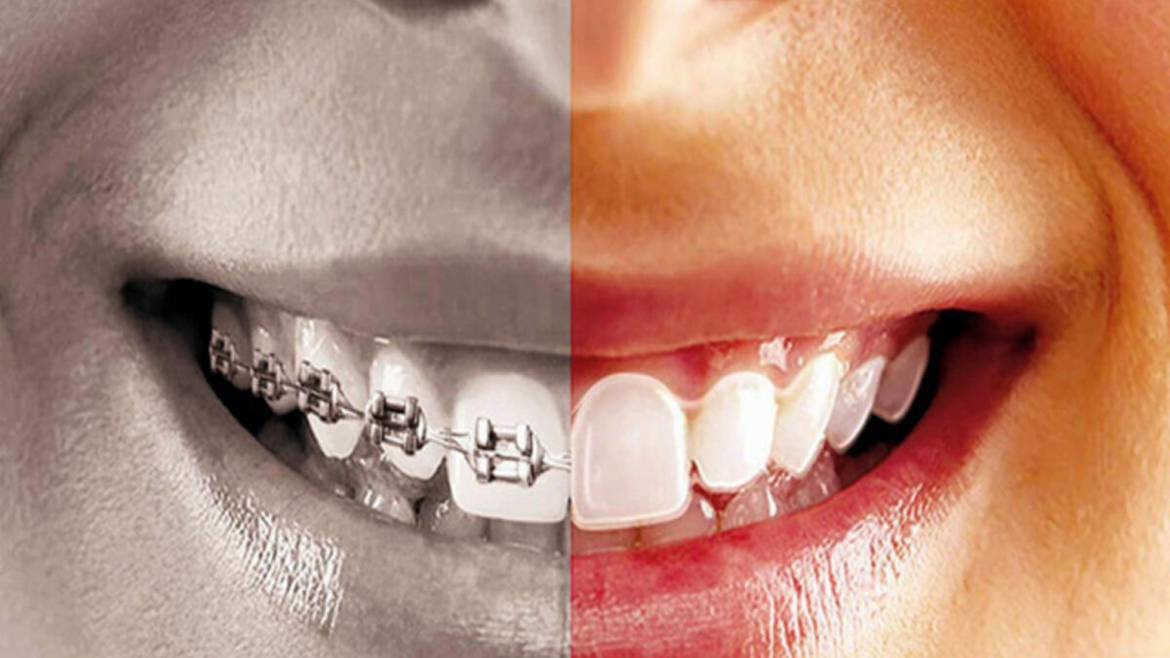 Orthodontic Treatment