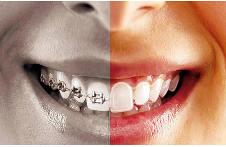 علاج تقويم الأسنان اللاسلكي