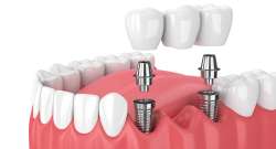 Wie wird eine Zahnbrückenbehandlung durchgeführt?
