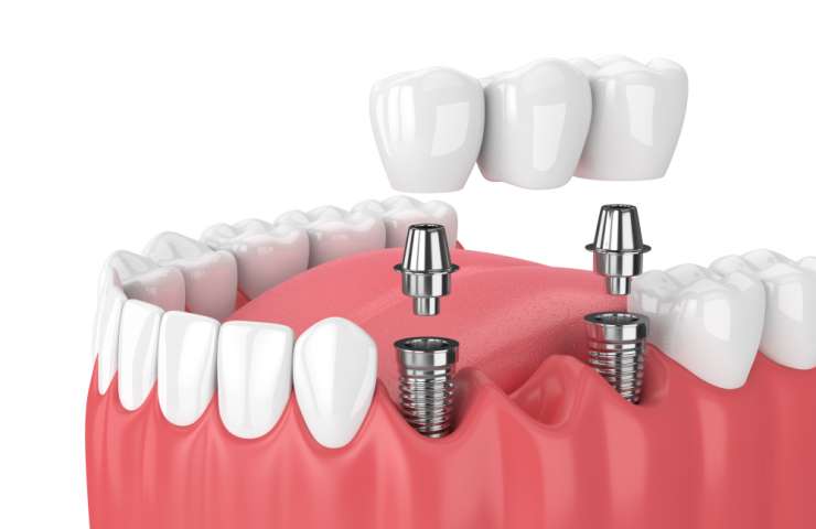 Wie wird eine Zahnbrückenbehandlung durchgeführt?