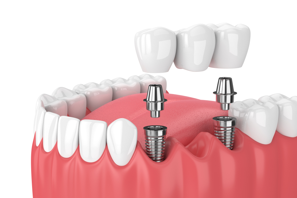 Dental Köprü Tedavisi Nasıl Yapılır?