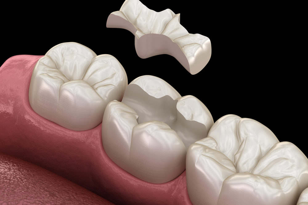 Inlay ve Onlay Dolgu
