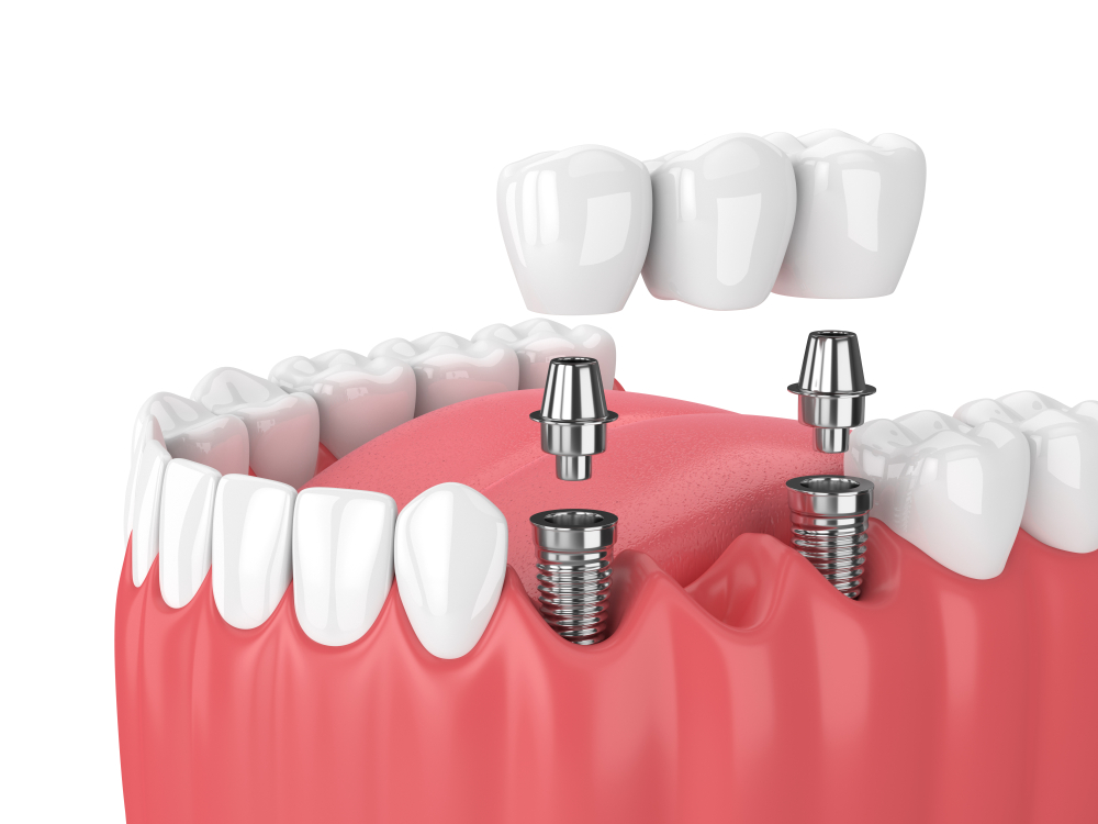 Zahnbrücke 1 dental köprü
