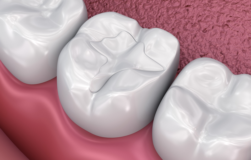 Diş dolgusu tedavisinin üç boyutlu tasarımı