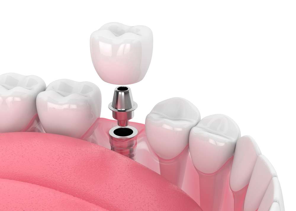 Implantatpreise 2025: Aktuelle Implantatpreise
