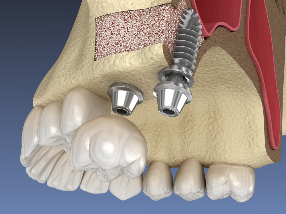 sinus lifting