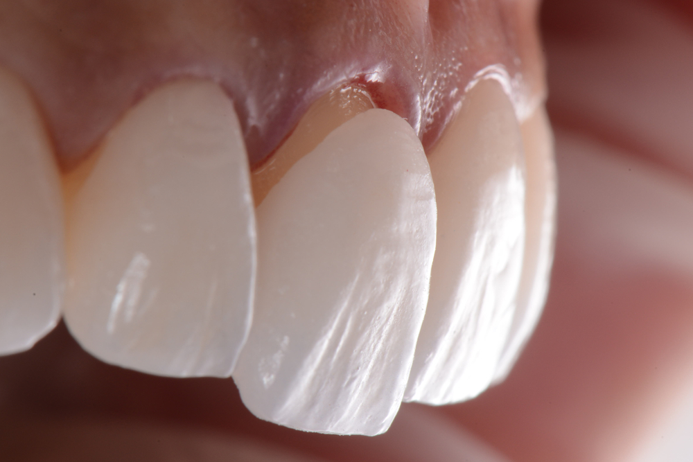 Porselen Lamine Tedavileri - İstanbul - Kadıköy Diş Kliniği - Göztepe Diş Kliniği - Estetik Diş Kliniği