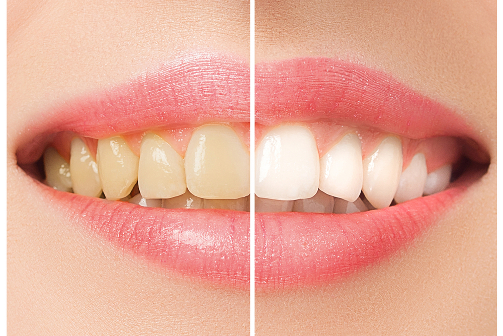 Diş beyazlatma uygulanmış kadın agzı