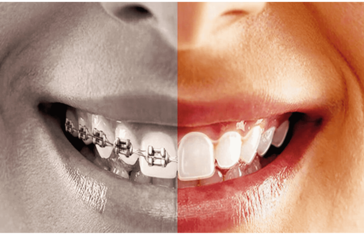 علاج تقويم الأسنان بدون أسلاك
