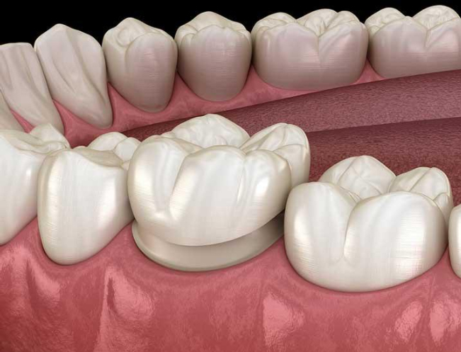 بورسلين لامينيت أم تركيبة الزركونيوم؟ أي من العلاجين مناسب لك؟